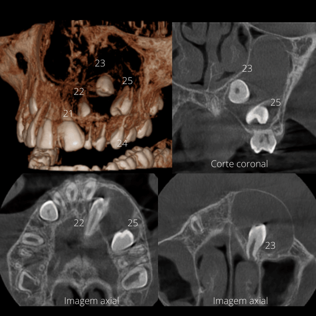 Tumor odontogênico adenomatoide