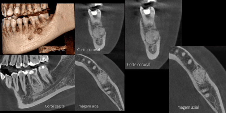 Cementoblastoma
