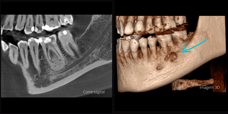 Cementoblastoma
