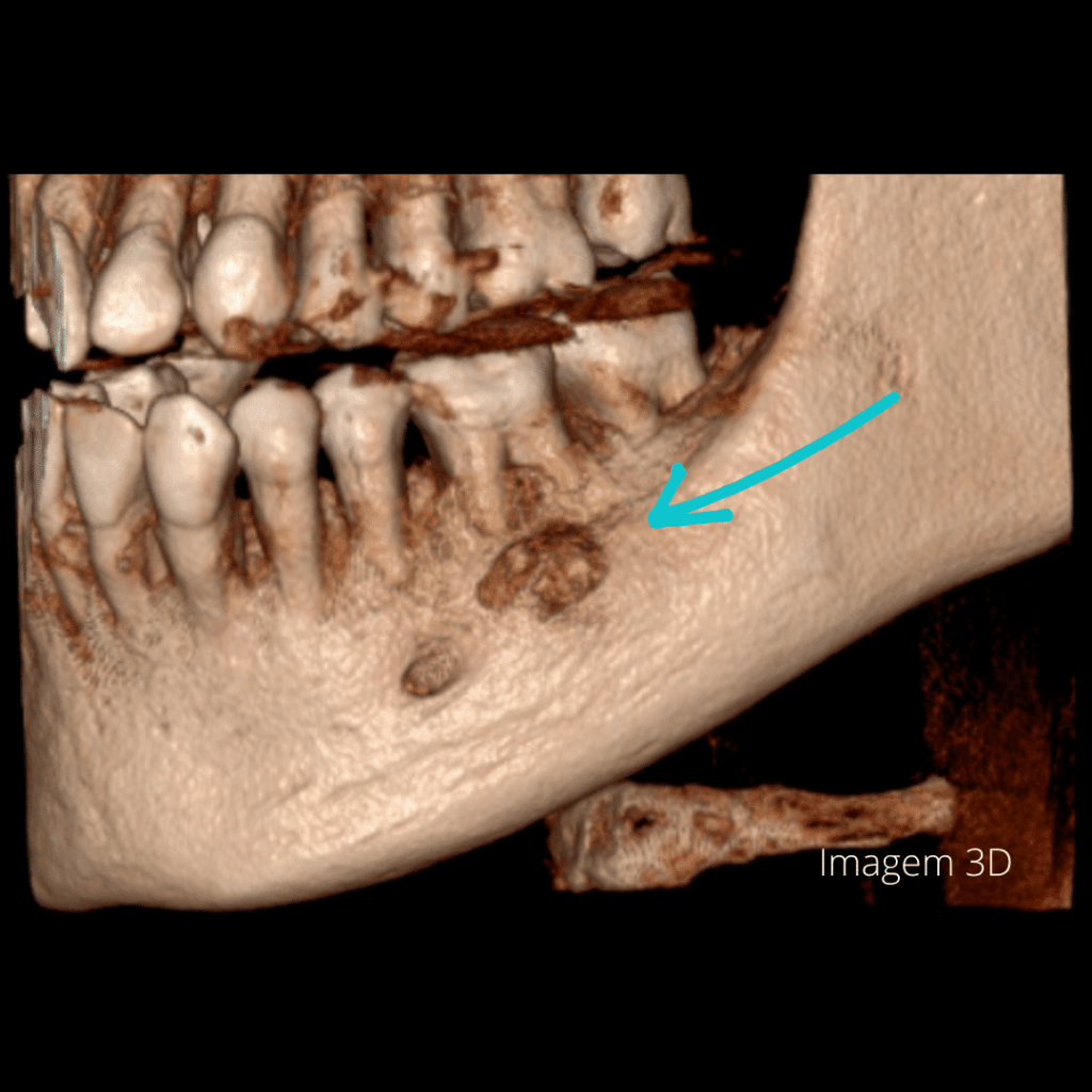 Cementoblastomas