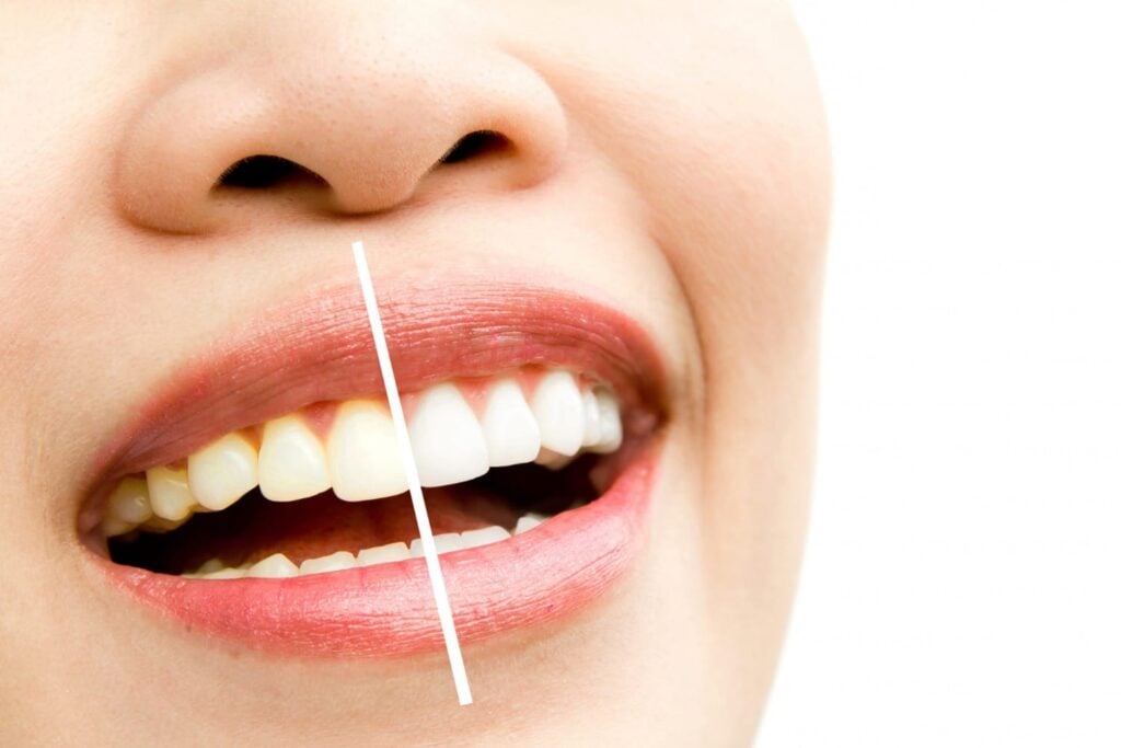 dentes amarelados