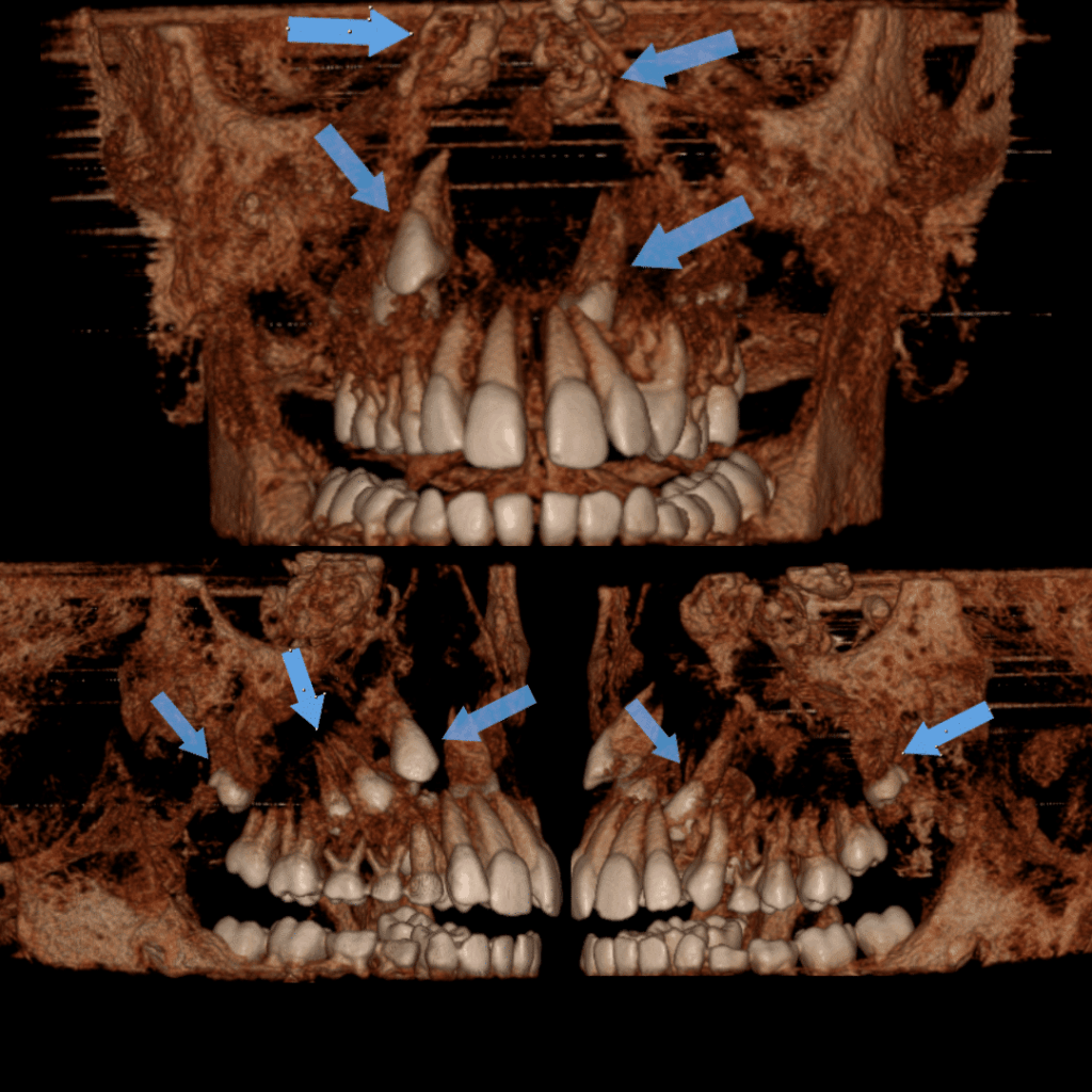 Displasia Cleidocraniana e Síndrome de Gardner - Tomografia