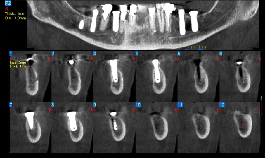Invasão do espaço do canal mandibular
