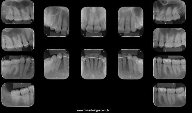 levantamento periapical