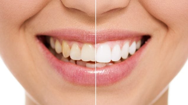 Sorriso dividido ao meio com a metade esquerda sem tratamento e a metade direita já tratada
