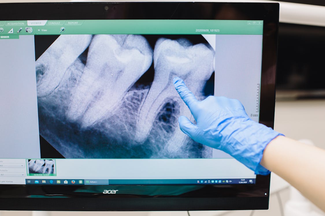 radiografia periapical