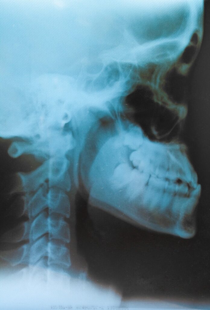 radiografia de cavum