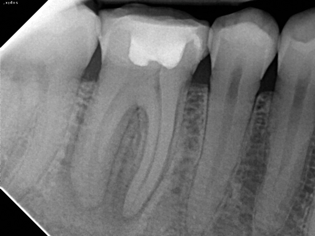 radiografia periapical
