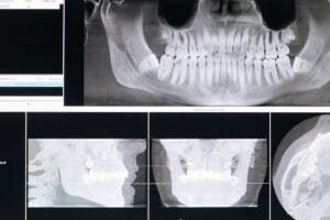 Radiografia Intrabucal