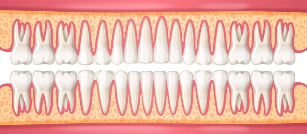 reabsorção da raiz do dente