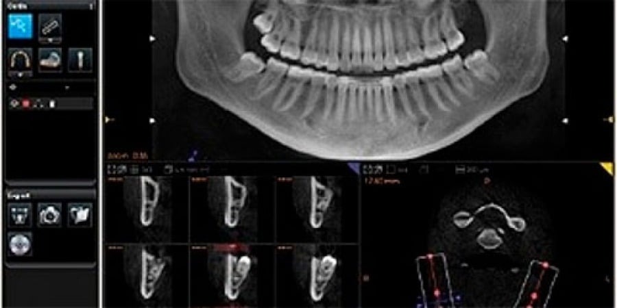 exame panorâmico de tomografia computadorizada de uma arcada dentária