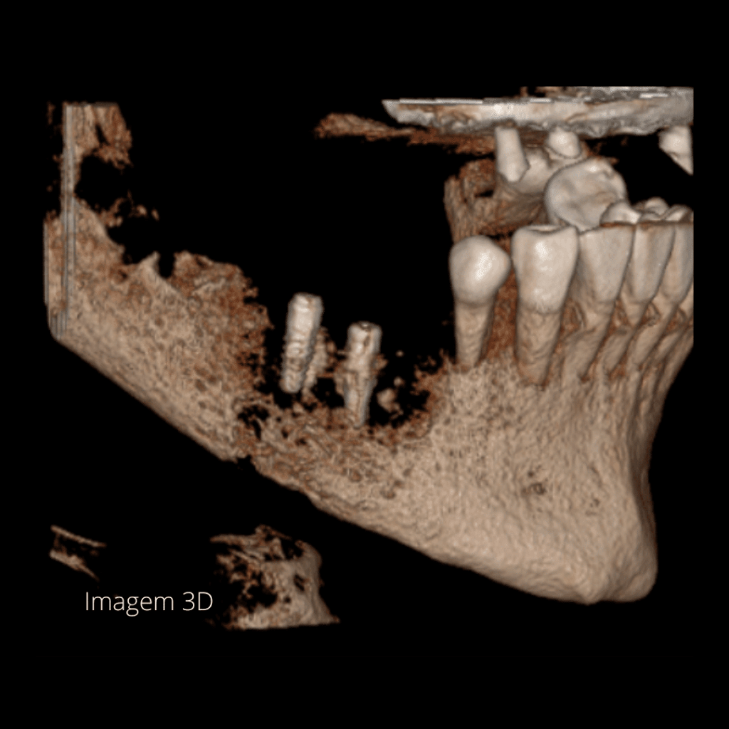 Osteomielite Mandibular