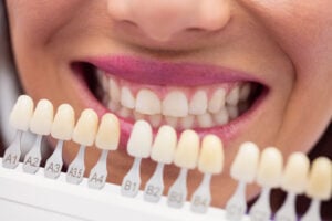 lentes de contato dental