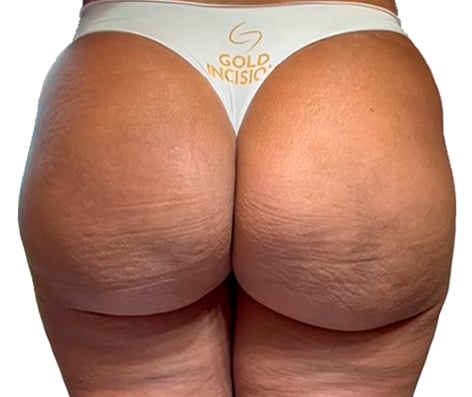 1-depois
