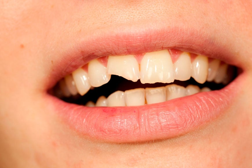 Close-up de boca aberta mostrando dente da frente quebrado com rachadura visível