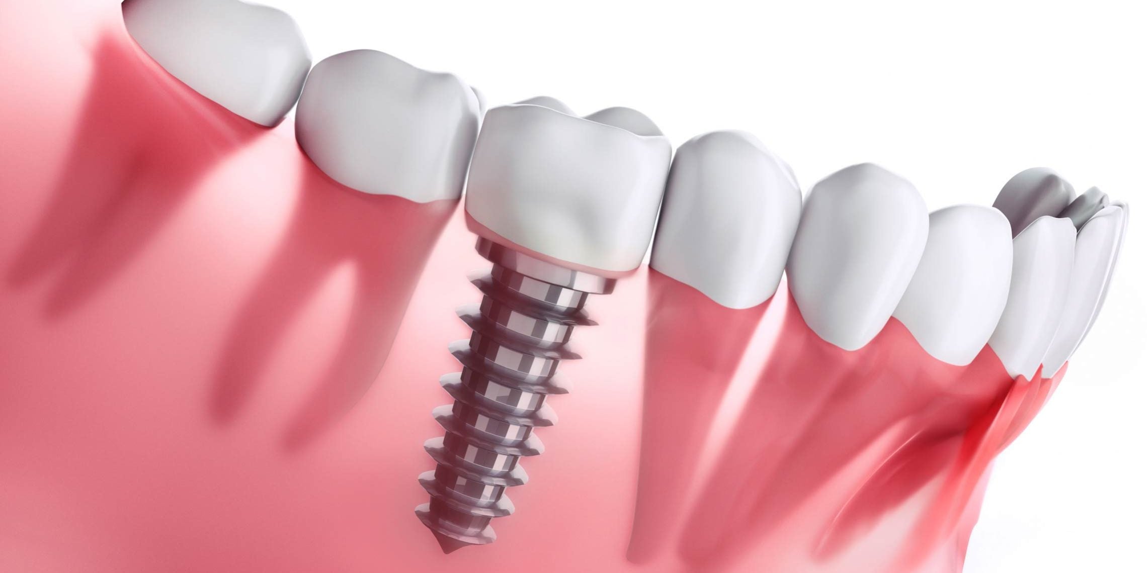 Dentista orientando paciente sobre higienização de implante dentário na clínica