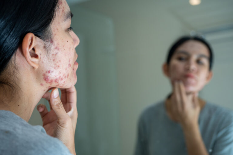 Tratamento da acne vulgar: o que mostrou o estudo clínico com 40 pacientes